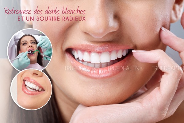 Blanchiment des dents (Quick white) + Détartrage + Polissage