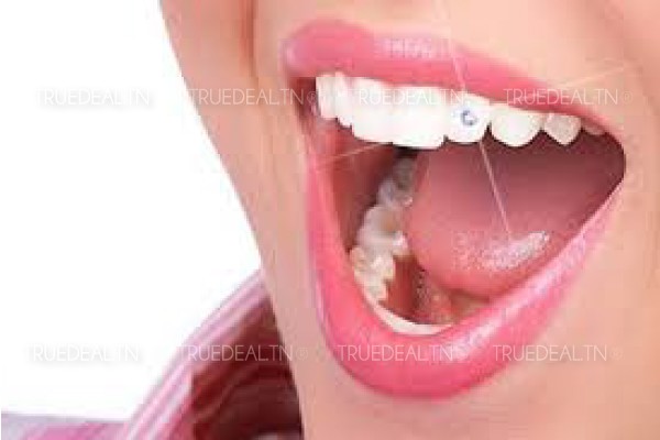 Archivé: Ornez vos Dents d’un Strass Dentaire swarovski (plusieurs couleurs disponibles)