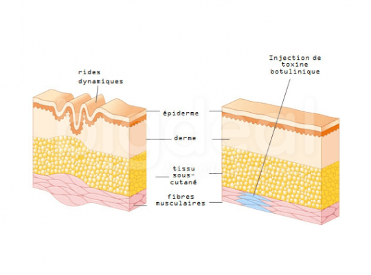 Injection de Botox